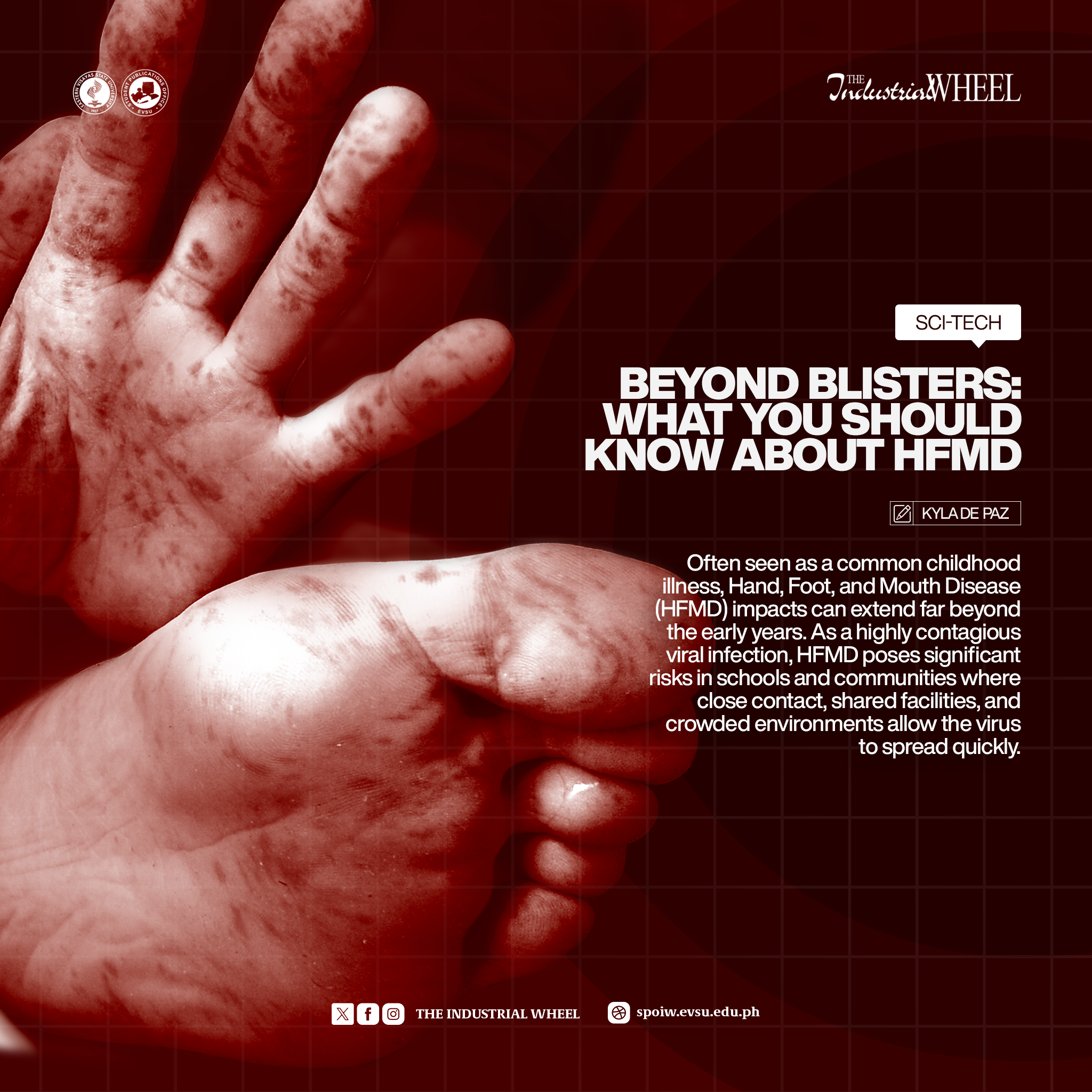 Beyond Blisters: What you should know about HFMD