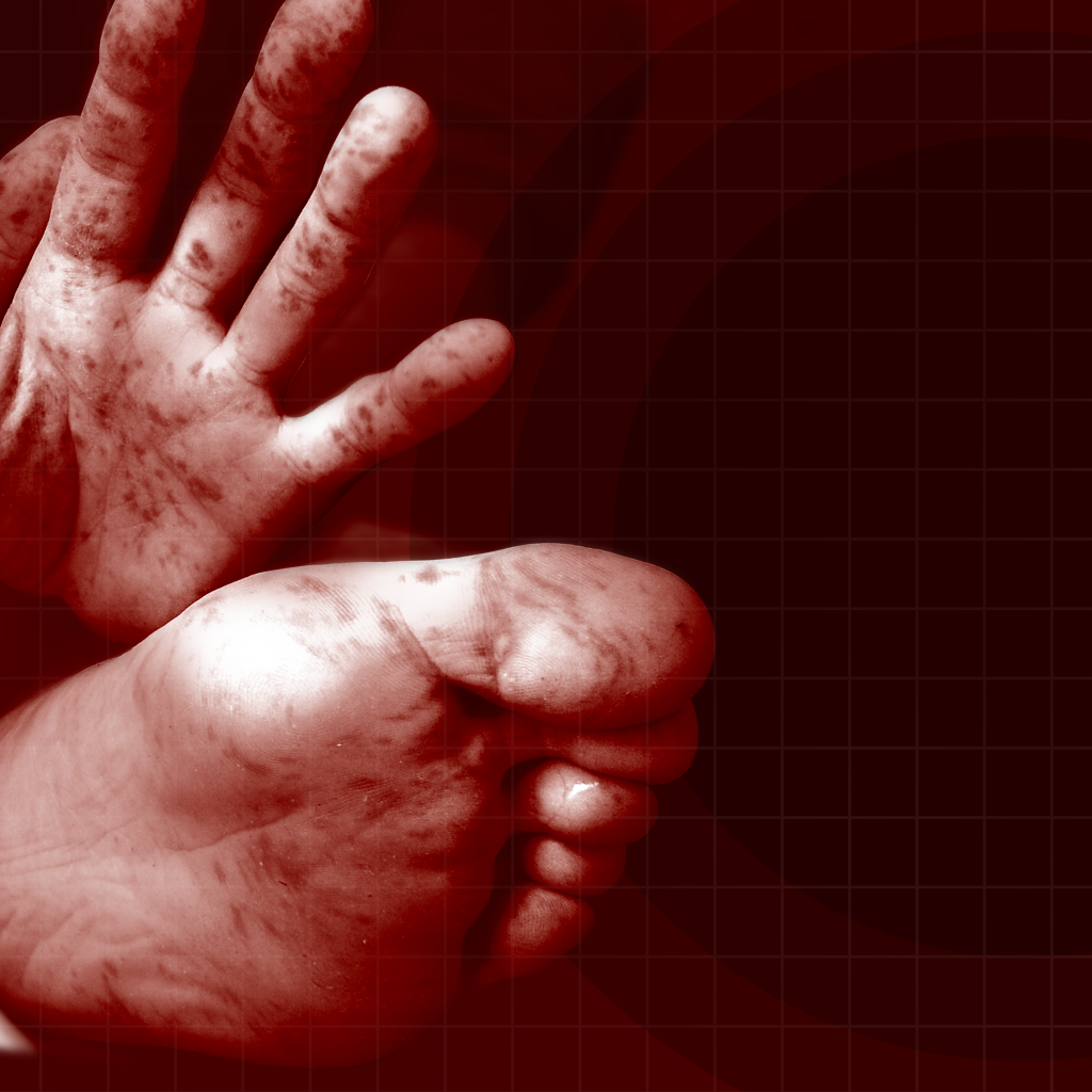 Beyond Blisters: What you should know about HFMD
